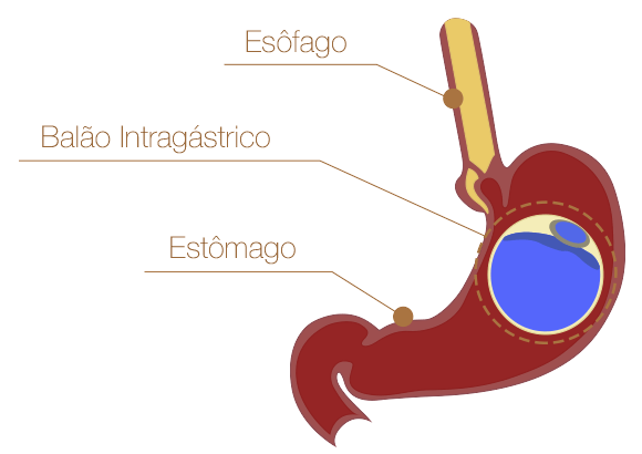 Balão Intragástrico