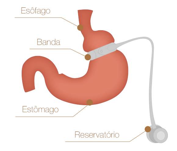 Banda Gástrica